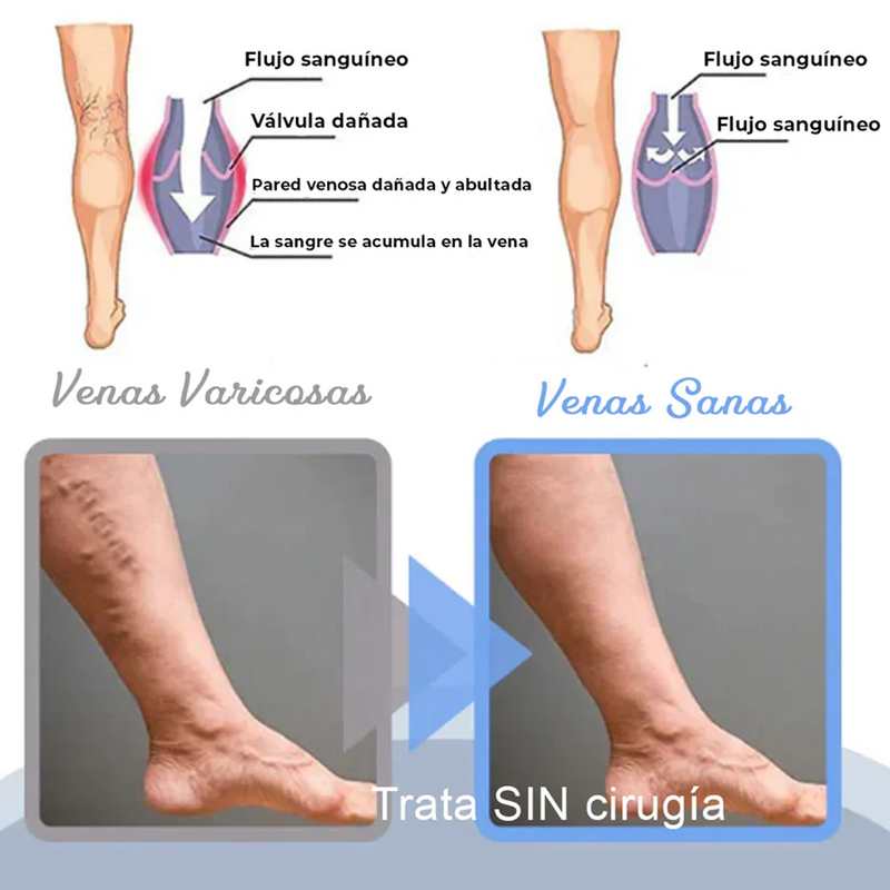 Spray Anti-Varices